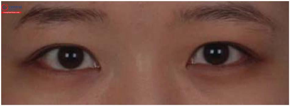 Tạo mắt hai mí không phẫu thuật: quy trình và lưu ý