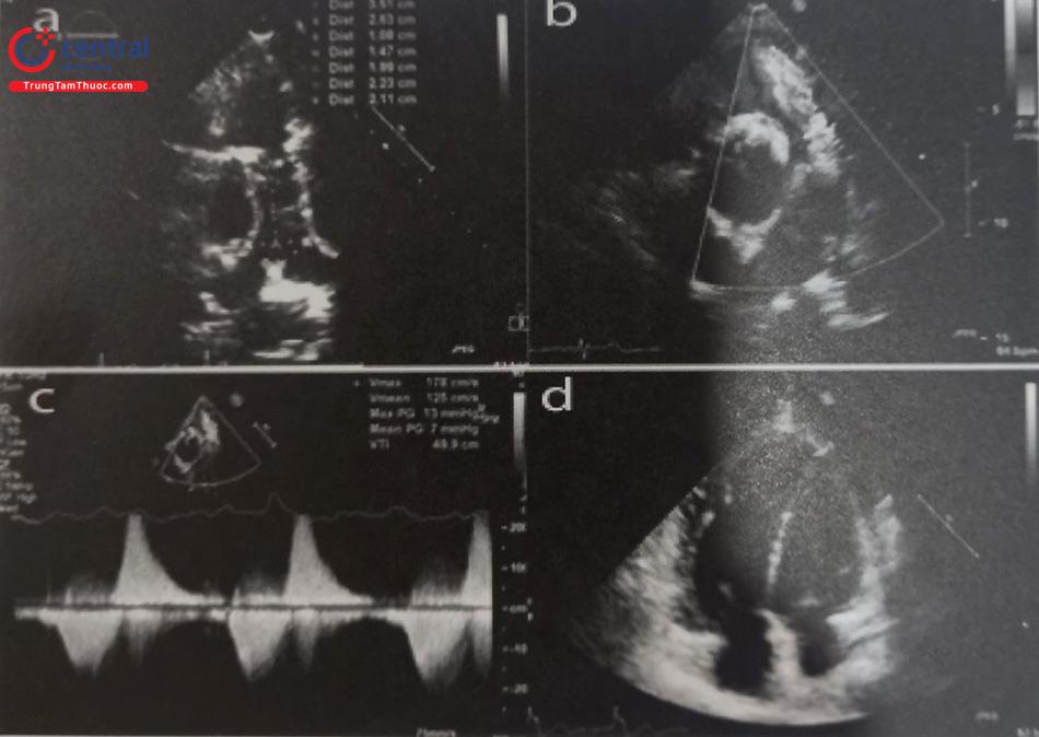 Hình 39.1. Hình ảnh siêu âm tim qua thành ngực ở bệnh nhân rối loạn chức năng van homograft động mạch phổi.