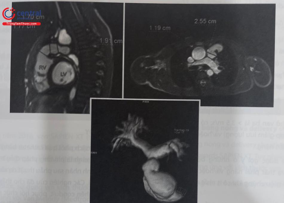 Hình 39.2. Hình ảnh chụp MRI tim ở bệnh nhân rối loạn chức năng van động mạch phổi sinh học homograft. (Nguồn: Gianfranco Butera. Atlas of Cardiac Catheterization for Congenital Heart Disease, 2019)