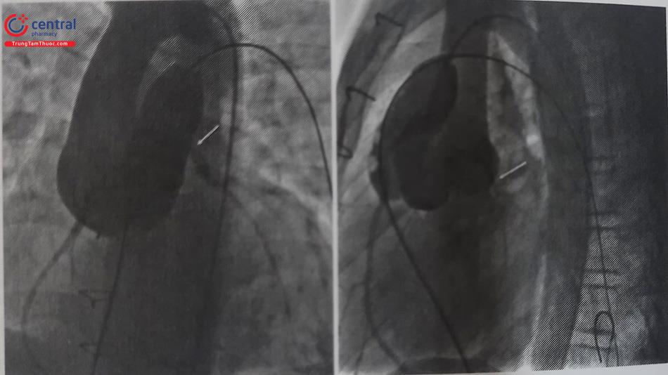 Hình 39.8. Phim chụp mạch gốc động mạch chủ trong quá trình bơm bóng trong homograft cho thấy hình ảnh tưới máu các động mạch vành bình thường (mũi tên)
