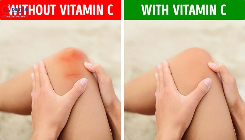 Thiếu hụt vitamin C các mạch máu nhỏ có thể bị vỡ hình thành các vết bầm tím.