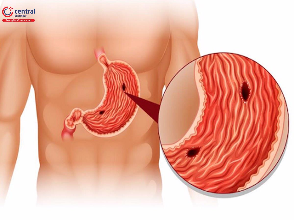 Viêm loét dạ dày tá tràng có thể gây ra thủng dạ dày