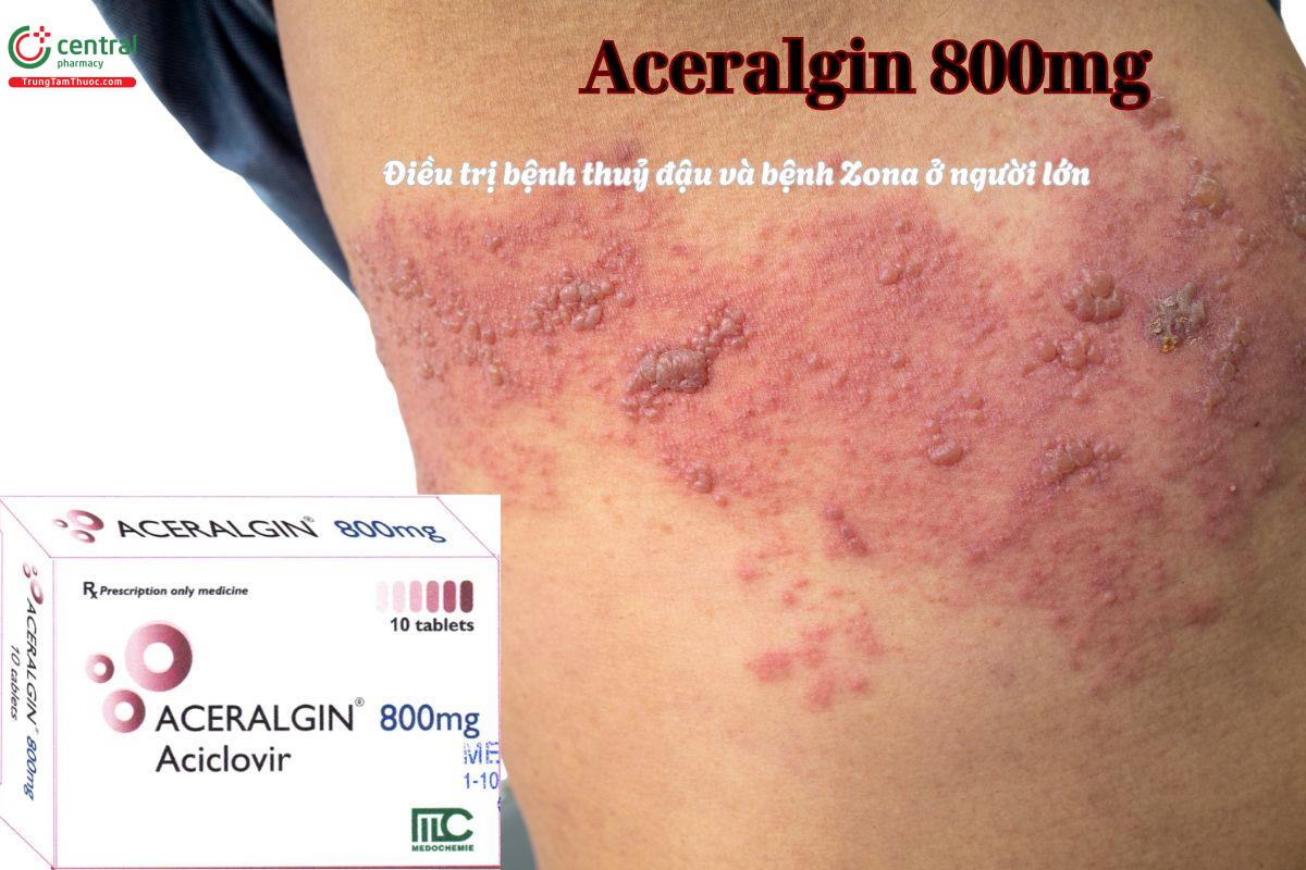 Thuốc Aceralgin 800mg điều trị bệnh zona ở người lớn