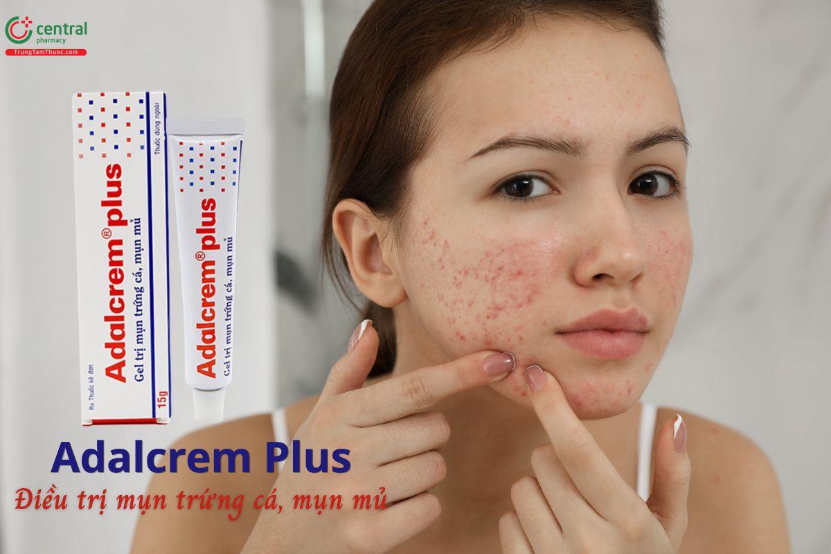 Thuốc Adalcrem Plus - Gel bôi da điều trị mụn trứng cá, mụn mủ, mụn viêm