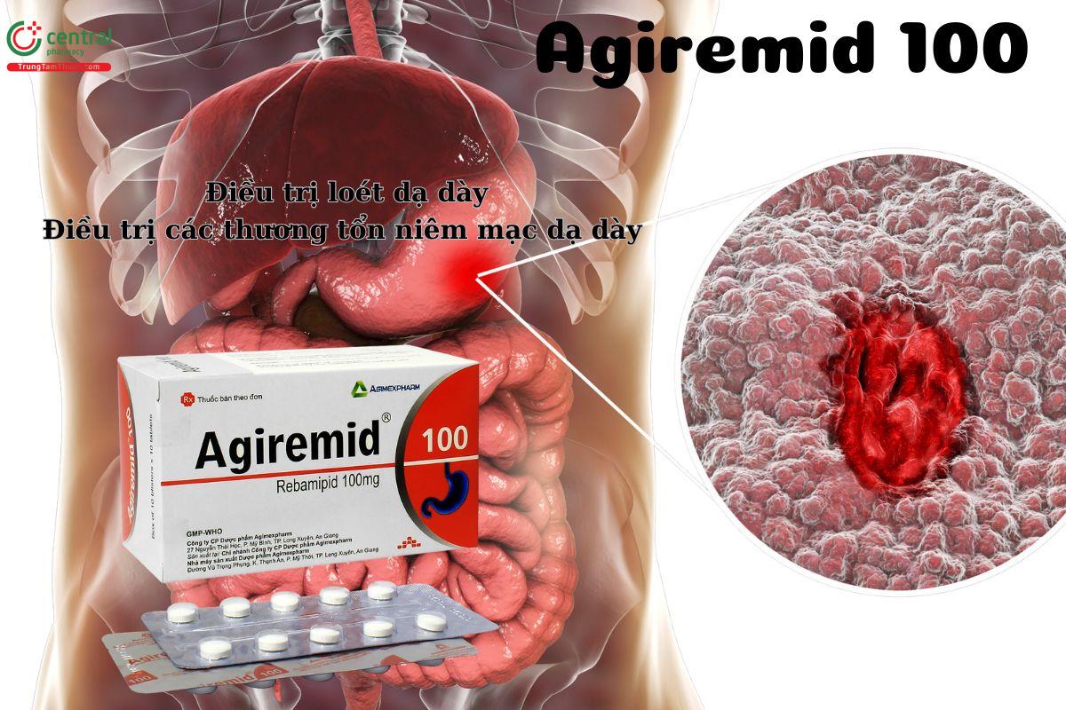 Thuốc Agiremid 100mg điều trị bệnh loét dạ dày