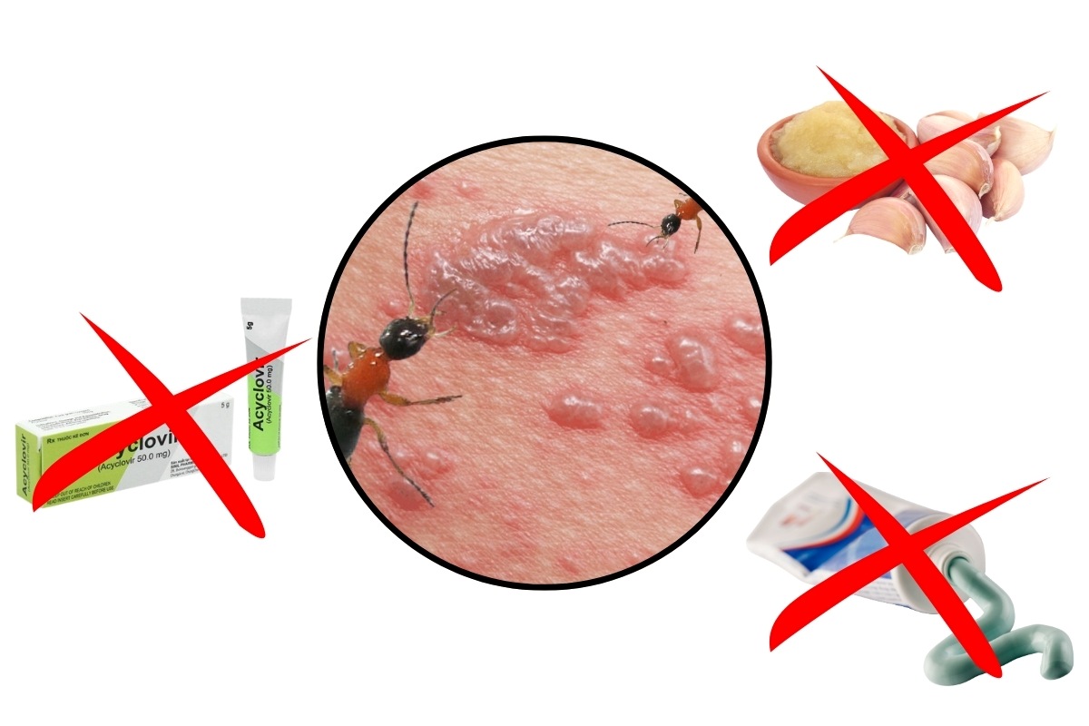 Không được bôi gì lên vị trí bị kiến ba khoang đốt?