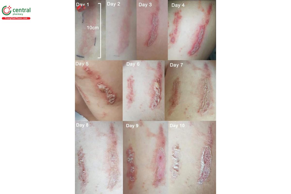 Triệu chứng viêm da do tiếp xúc dịch độc của kiến ba khoang