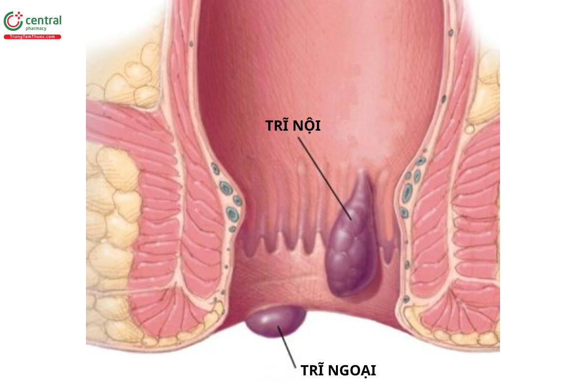 Bệnh trĩ chia làm 2 loại là trĩ nội và trĩ ngoại