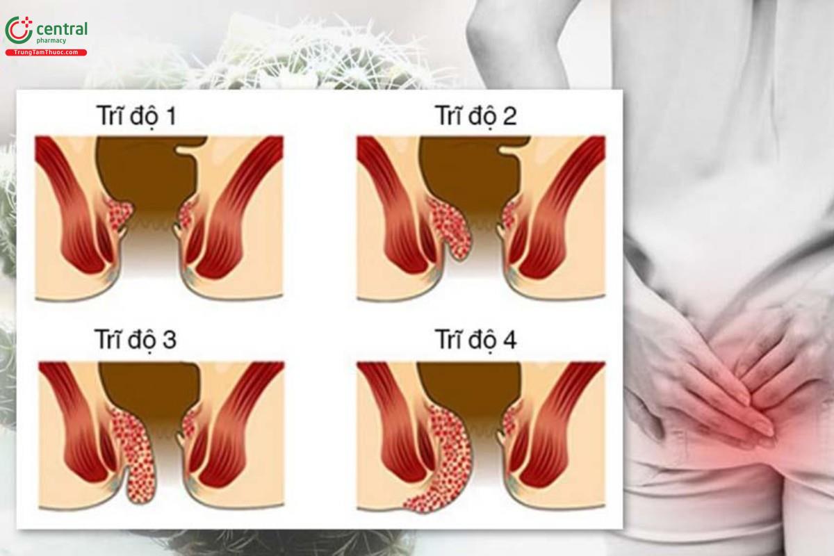 Phân loại theo sự tiến triển của búi trĩ