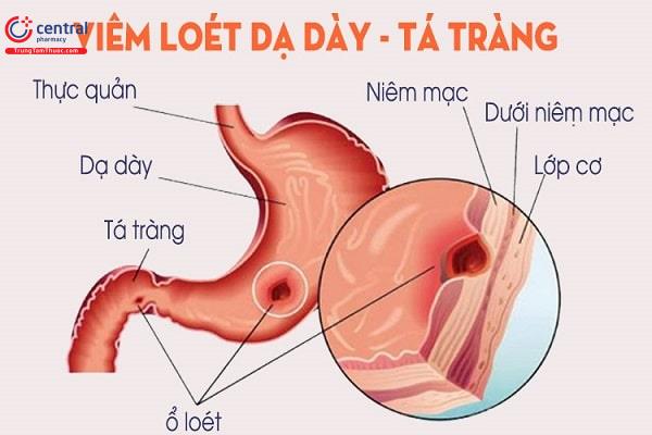 Hình 3: Loét dạ dày tá tràng