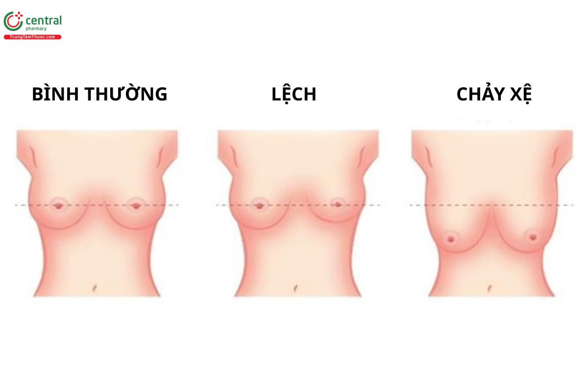 Nên lựa chọn sản phẩm khác nhau cho ngực lệch và ngực chảy xệ