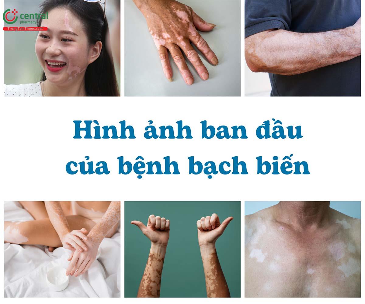 Một số hình ảnh ban đầu của bệnh bạch biến