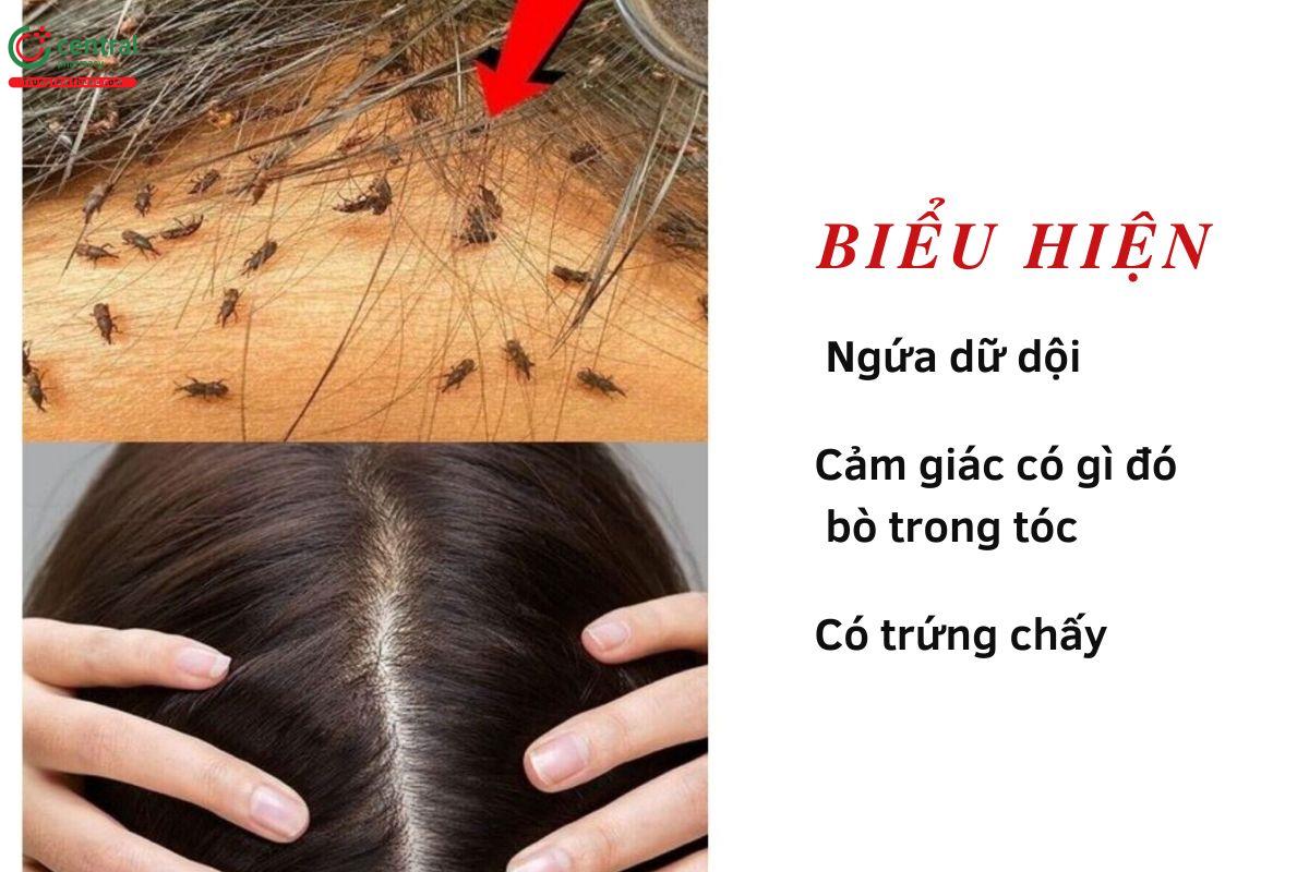 Biểu hiện khi bị chấy