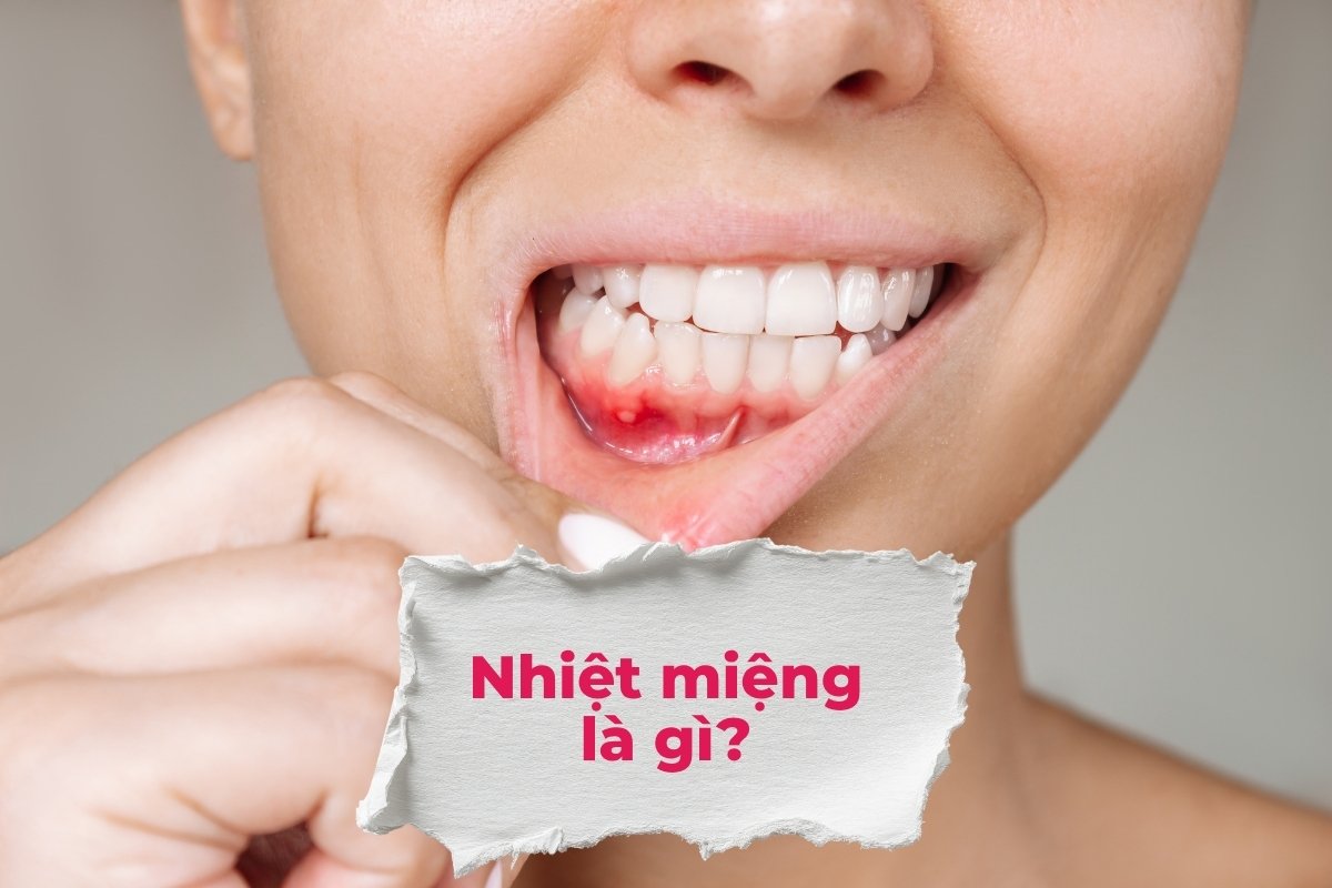 Nhiệt miệng là gì?