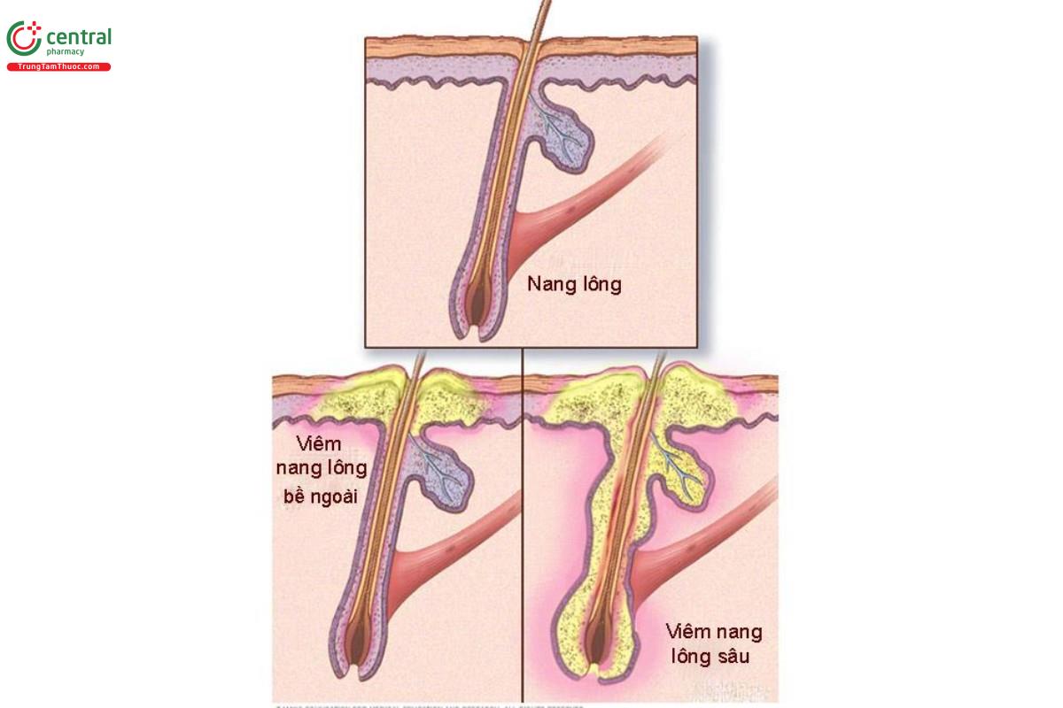 Viêm nang lông bề mặt và viêm nang lông sâu