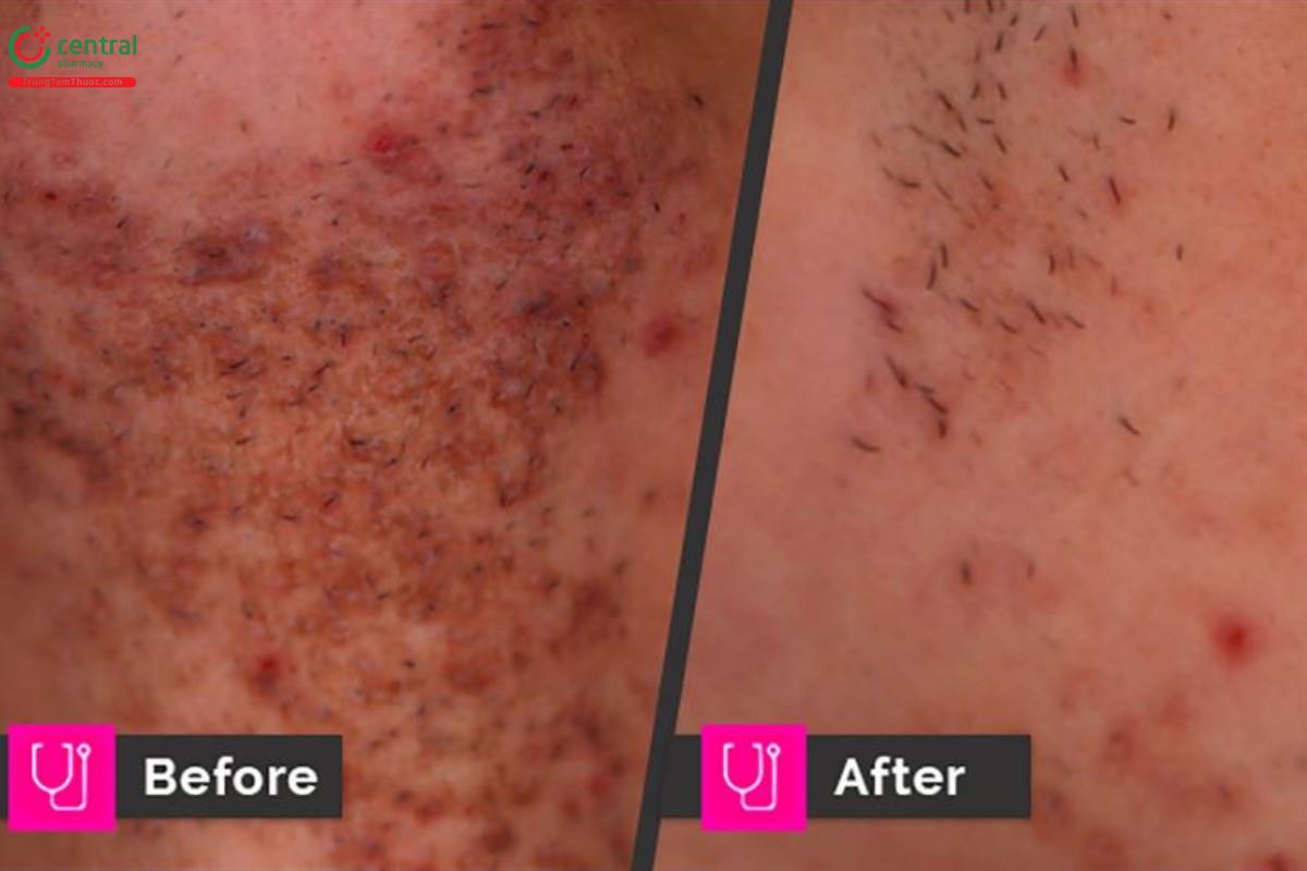 Trước và sau khi điều trị viêm nang lông bằng laser