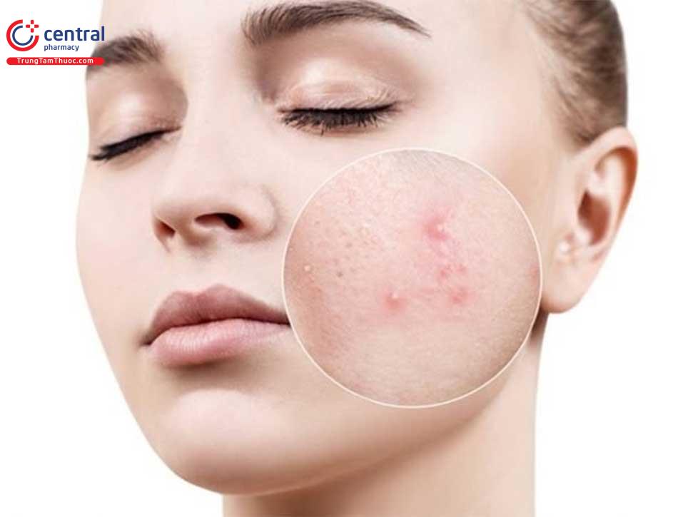 Da tiết nhiền bã nhờn và nổi nhiều mụn có thể là do mất cân bằng nội tiết