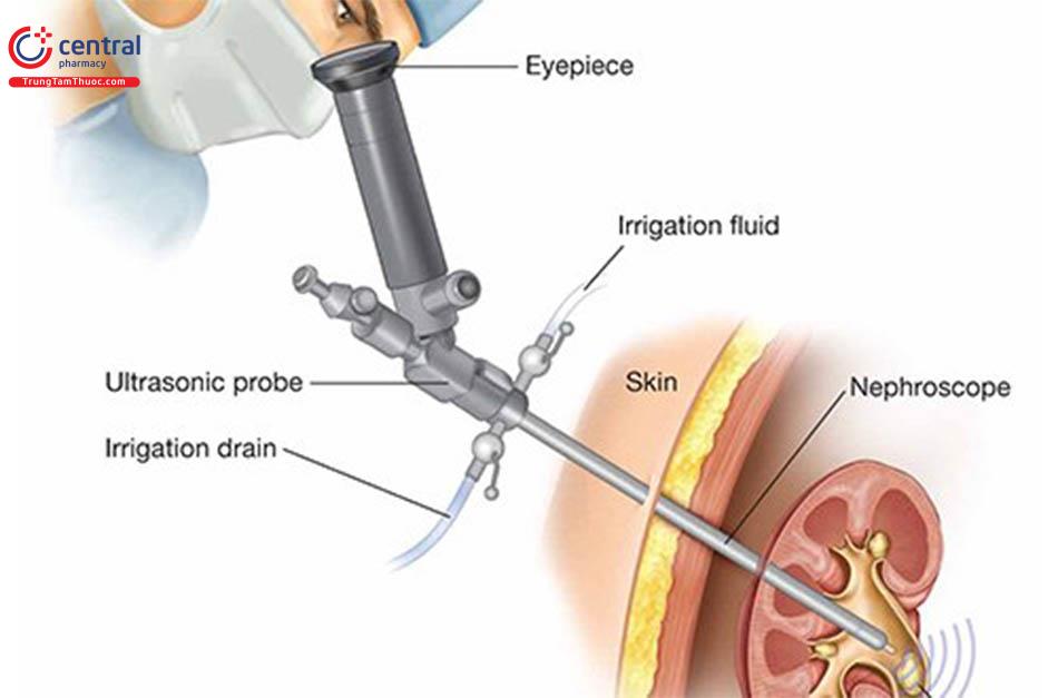 Điều trị sỏi thận bằng tán sỏi ngoài cơ thể