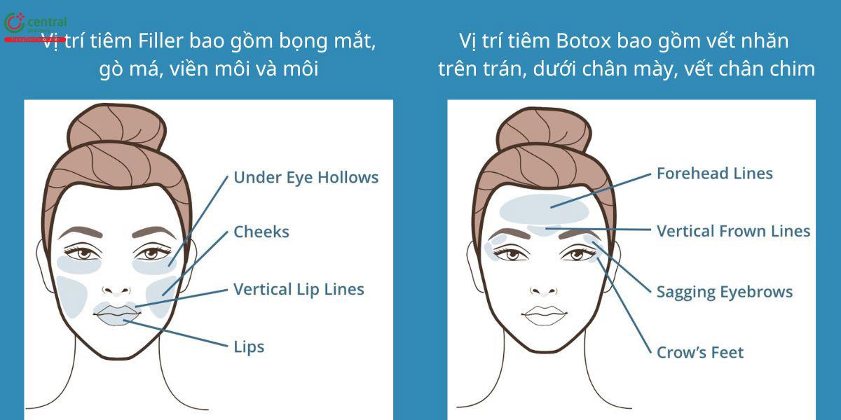 Phân biệt tiêm filler và tiêm Botox