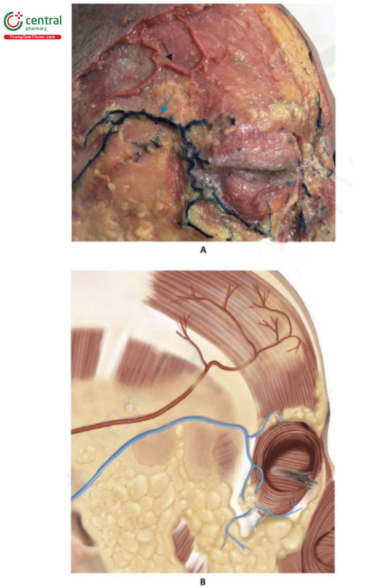 Hình 7.9 A. Nhánh trước hoặc trán của động mạch thái dương nông (STA) (mũi tên đen) và tĩnh mạch thái  dương giữa (MTV) (mũi tên xanh), được dẫn lưu bởi tĩnh mạch trên mi của vùng lông mày và mí mắt trên và bởi tĩnh mạch gò má- mặt và ổ mắt của vùng má và mí mắt dưới. B. Hình minh họa A cho thấy STA và  MTV nằm trên cơ thái dương. 