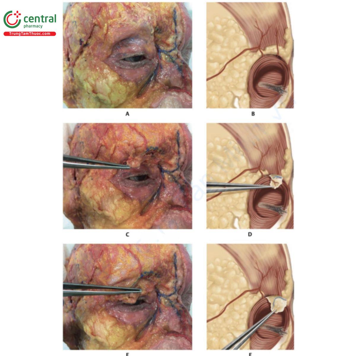 Hình 7.11 A. Xác tươi sau loại bỏ da và lớp mỡ nông (SFP) vùng lông mày. Cơ vòng mắt (OM) có thể thấy  nằm trên cơ trán. B. Hình minh họa tương ứng với A. C. Xác tươi với phần ổ mắt của OM được gập về phía trước, bộc lộ tĩnh mạch và động mạch trên ổ mắt. D. Hình minh họa tương ứng với C. E. Phần ổ mắt của  OM được gập hoàn toàn về phía trước, bộc lộ tĩnh mạch và động mạch trên ổ mắt nằm trên cơ trán. F. Hình  minh họa tương ứng với E. 