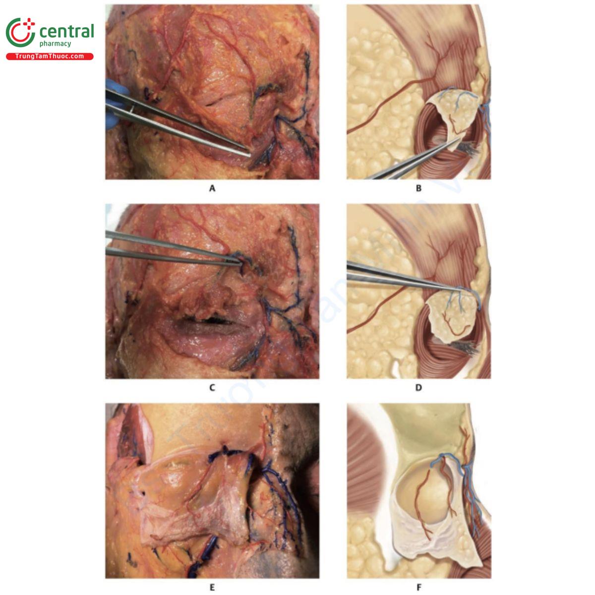 Hình 7.12 A. Xác tươi với phần ổ mắt của cơ vòng mắt (OM) được gập hoàn toàn, bộc lộ tĩnh mạch và động  mạch trên ổ mắt nằm trên cơ trán. Lưu ý viền xương quanh ổ mắt. B. Minh họa A. C. Động mạch và tĩnh  mạch trên ổ mắt được kéo lên, bộc lộ lỗ ra trên ổ mắt. D. Minh họa tương ứng với C. E. Cơ trán được gập  lại, bộc lộ tĩnh mạch và động mạch trên ổ mắt đi ra từ lỗ ra tương ứng. F. Minh họa E. 