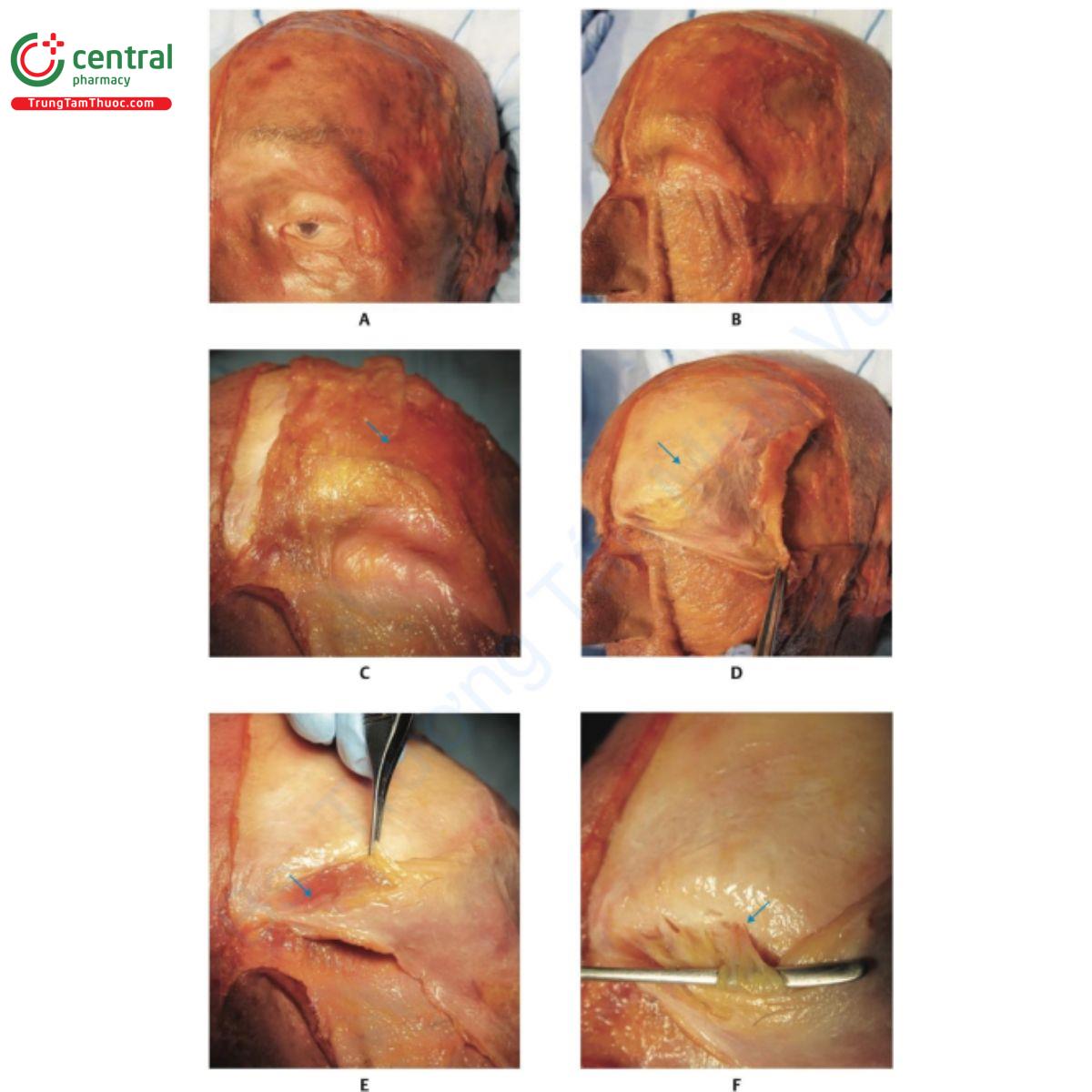 Hình 7.13 A và B. Hình nghiêng xác tươi với da được gập bộc lộ lớp mỡ nông (SFP) vùng lông mày. C. Da  vùng trán được loại bỏ. D. Cơ trán được gập lại bộc lộ cân ngoài sọ và xương trán (mũi tên màu xanh). E.  Cơ cau mày (mũi tên màu xanh) nằm dưới cơ trán. F. Lỗ ra trên ổ mắt và điểm ra của dây thần kinh, tĩnh  mạch và động mạch trên ổ mắt (mũi tên màu xanh) bên dưới cơ cau mày. 