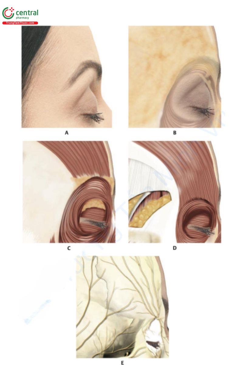 Hình 7.3 A. Hình nghiêng vùng lông mày. B. Sau khi loại bỏ da, cho thấy các lớp mỡ nông (SFP). C. Sau  khi loại bỏ da và SFP. Cơ trán và các phần mí và ổ mắt của cơ vòng mắt (OM) có thể thấy trên lớp mỡ ROOF. D. Sau khi loại bỏ: cân thái dương nông, phần ổ mắt của OM và ROOF. Phần thái dương của mỡ má  bên dưới cân thái dương sâu và bên trên cơ thái dương. E. Cấu trúc xương với sự phân bố thần kinh. 