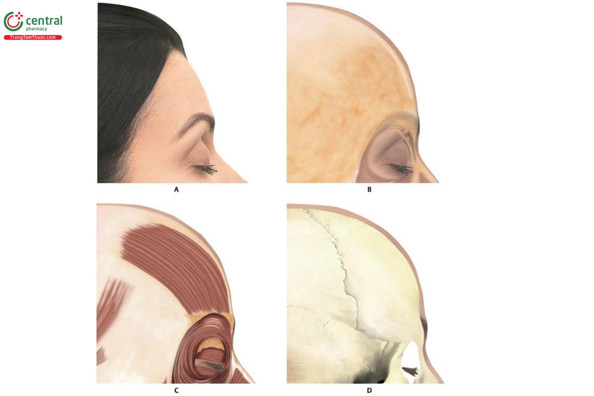 Hình 9.4 Hình nghiêng bên phải. A. Tập trung vào vùng gian mày. B. Sau khi loại bỏ da, bộc lộ lớp mỡ nông (SFP). C. Sau khi loại bỏ da và SFP, bộc lộ cơ trán và cơ vòng mắt (OM). Lớp mỡ sau cơ vòng mắt  (ROOF) có thể được thấy. D. Cấu trúc xương.