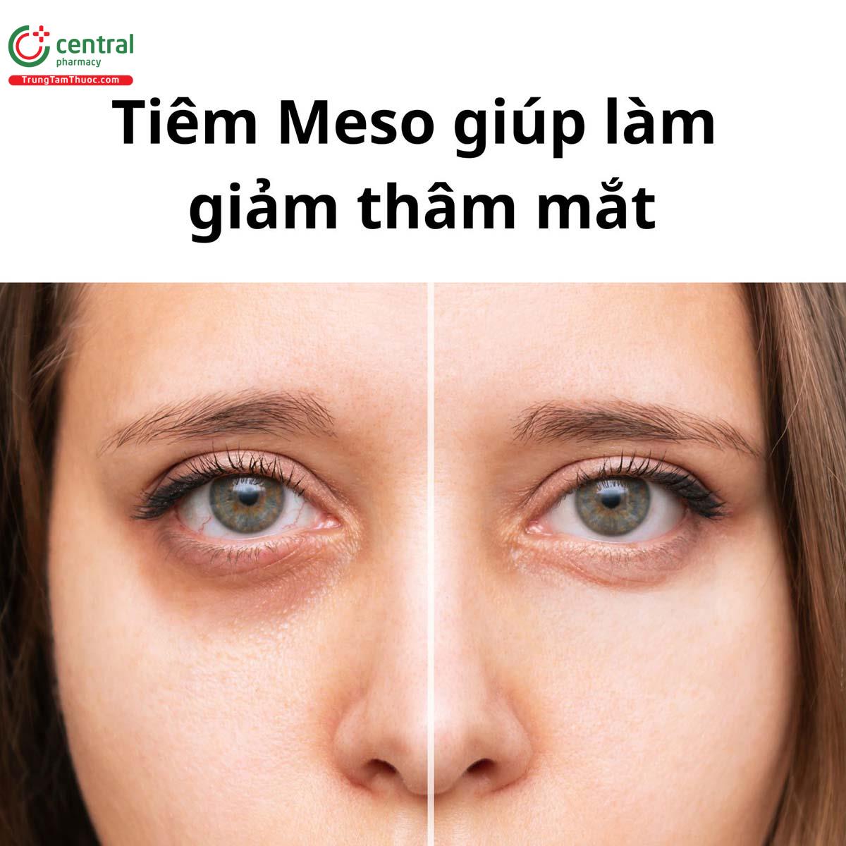 Giảm thâm mắt, bọng mắt