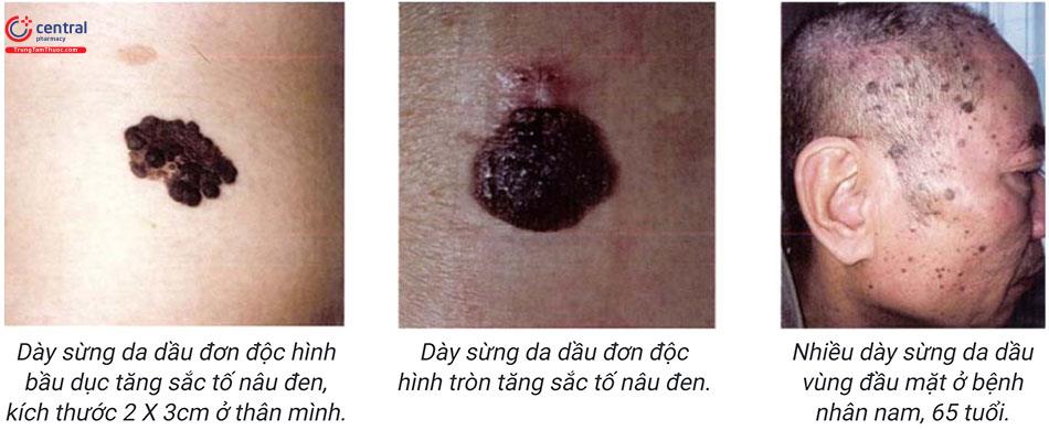 Tìm hiểu các loại u lành tính của da và cách điều trị
