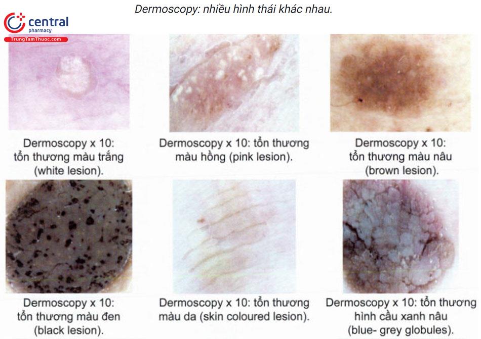 Tìm hiểu các loại u lành tính của da và cách điều trị