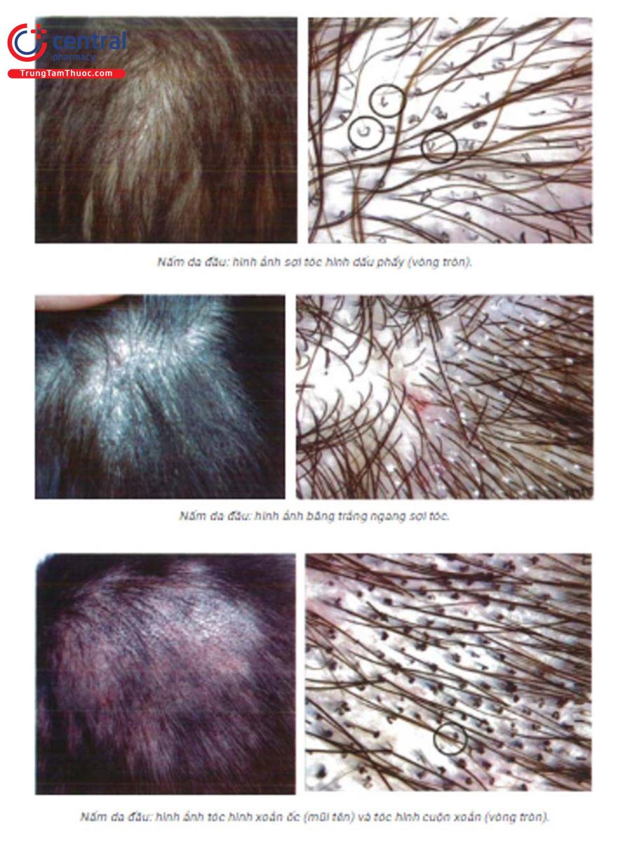Rụng tóc nhiều ở nữ: Nguyên nhân, triệu chứng và cách điều trị