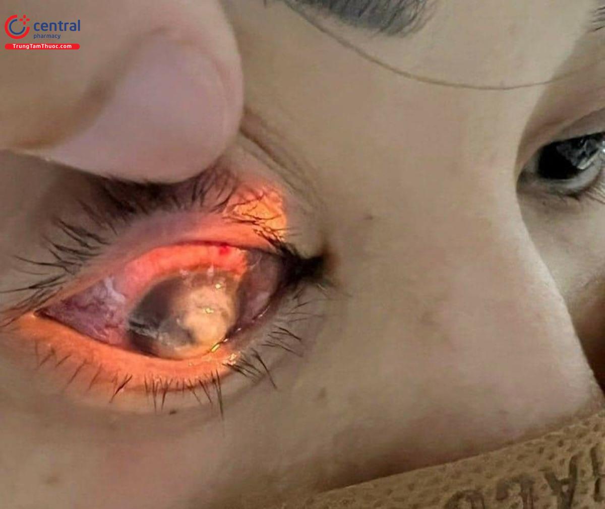 Tình trạng mắt của bệnh nhân sau khi tự ý sử dụng Corticosteroid để điều trị mắt đỏ 