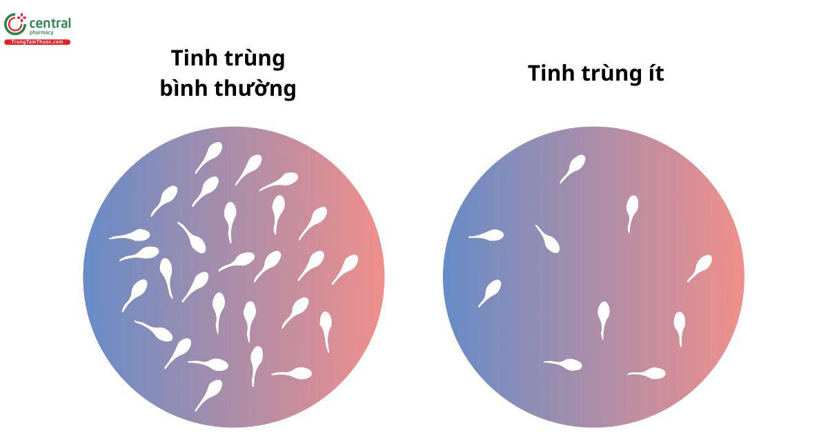 Bất thường về số lượng tinh trùng