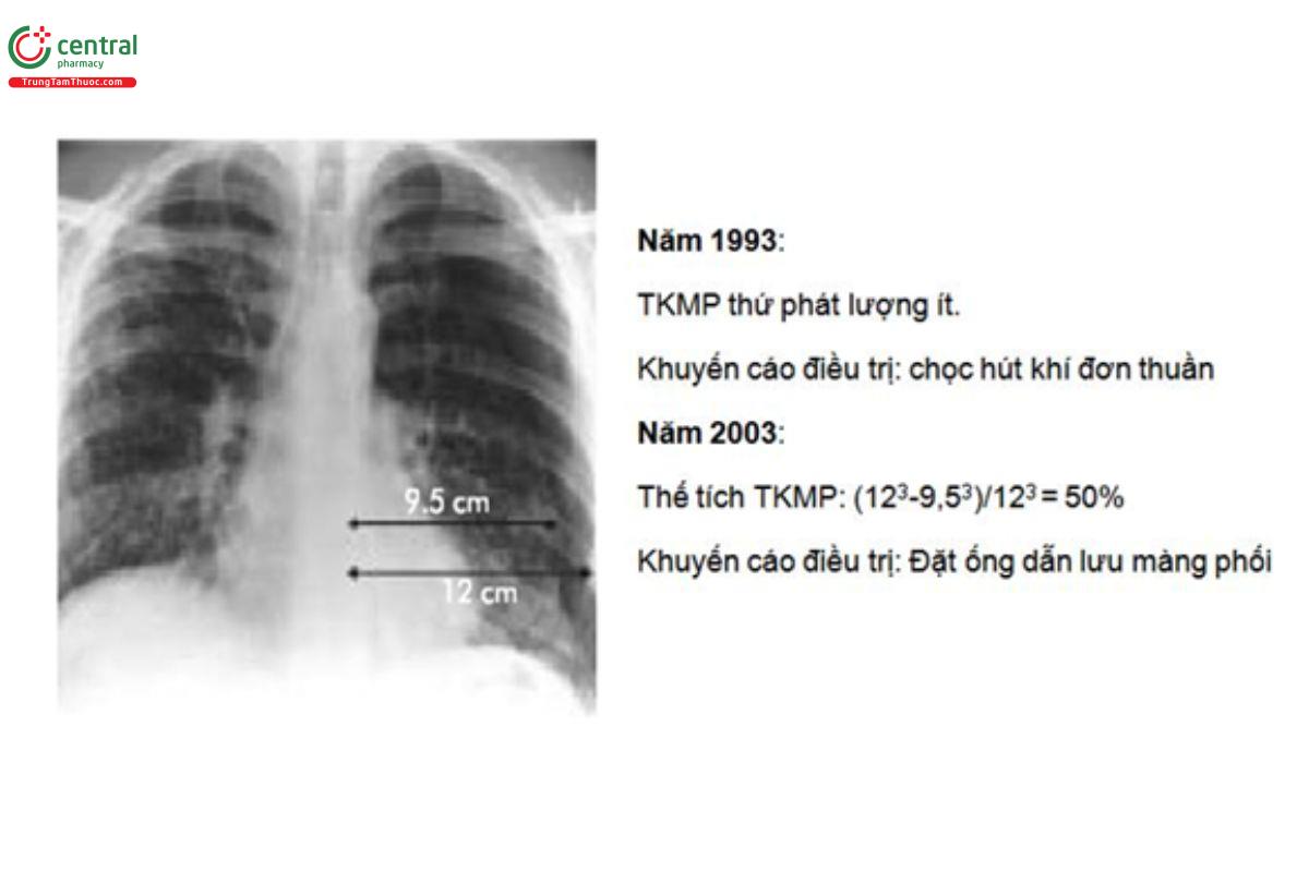 Hình 3. Ước tính kích thước TKMP: so sánh hướng dẫn 1993 và 2003 