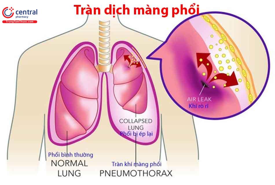 Tràn dịch màng phổi