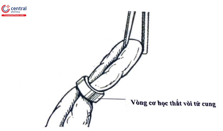 Hình 2. Dụng cụ cơ học sử dụng để tắc vòi tử cung 