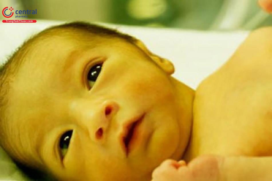 Các triệu chứng của tăng bilirubin gián tiếp gây vàng da ở trẻ sơ sinh