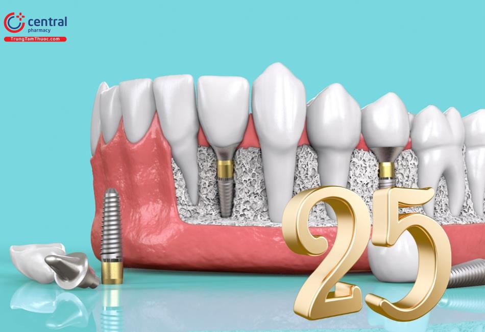 Răng implant có độ bền lên tới 25 năm