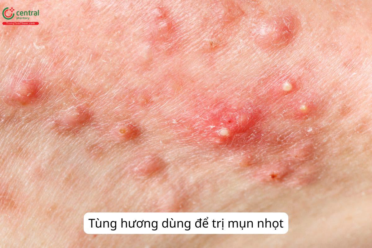 Tùng hương trị bệnh gì?