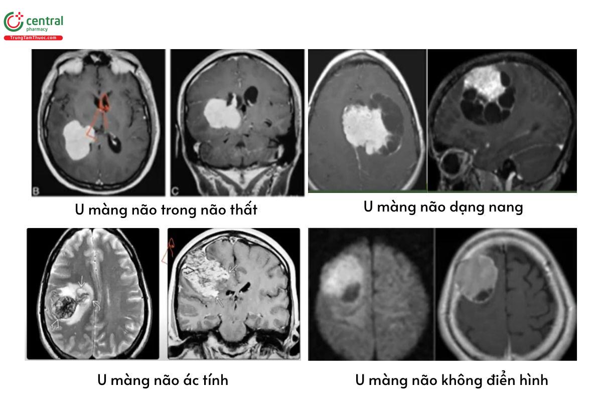 Một số hình ảnh về u màng não