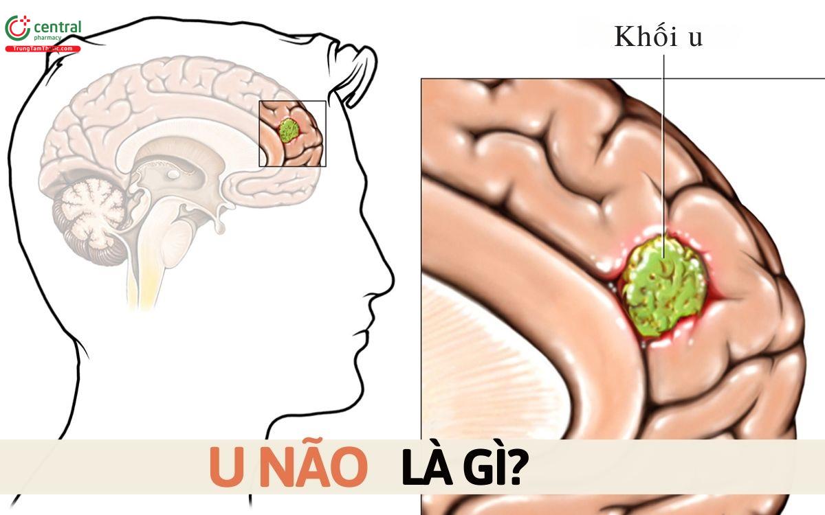 Tổng quan về u não