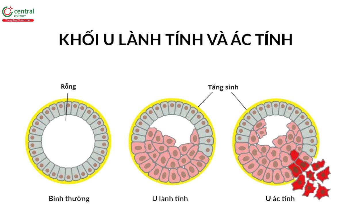 U não lành tính và ác tính