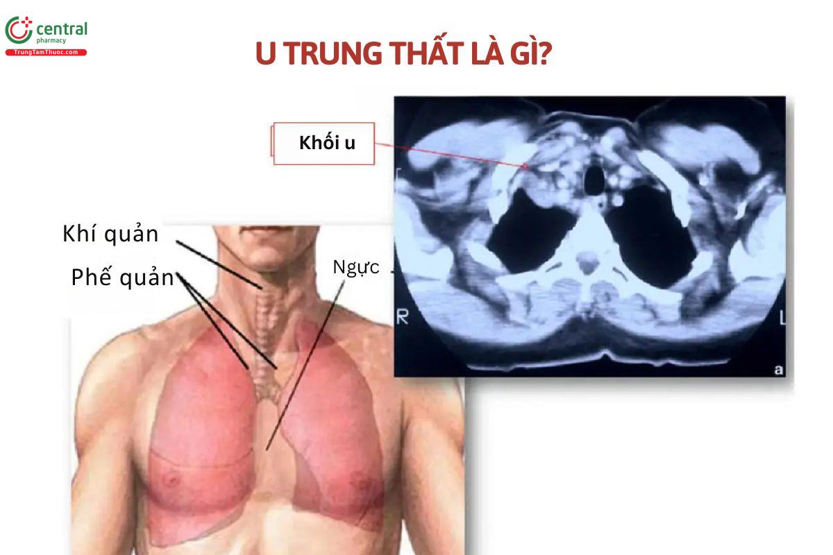 U trung thất là gì?