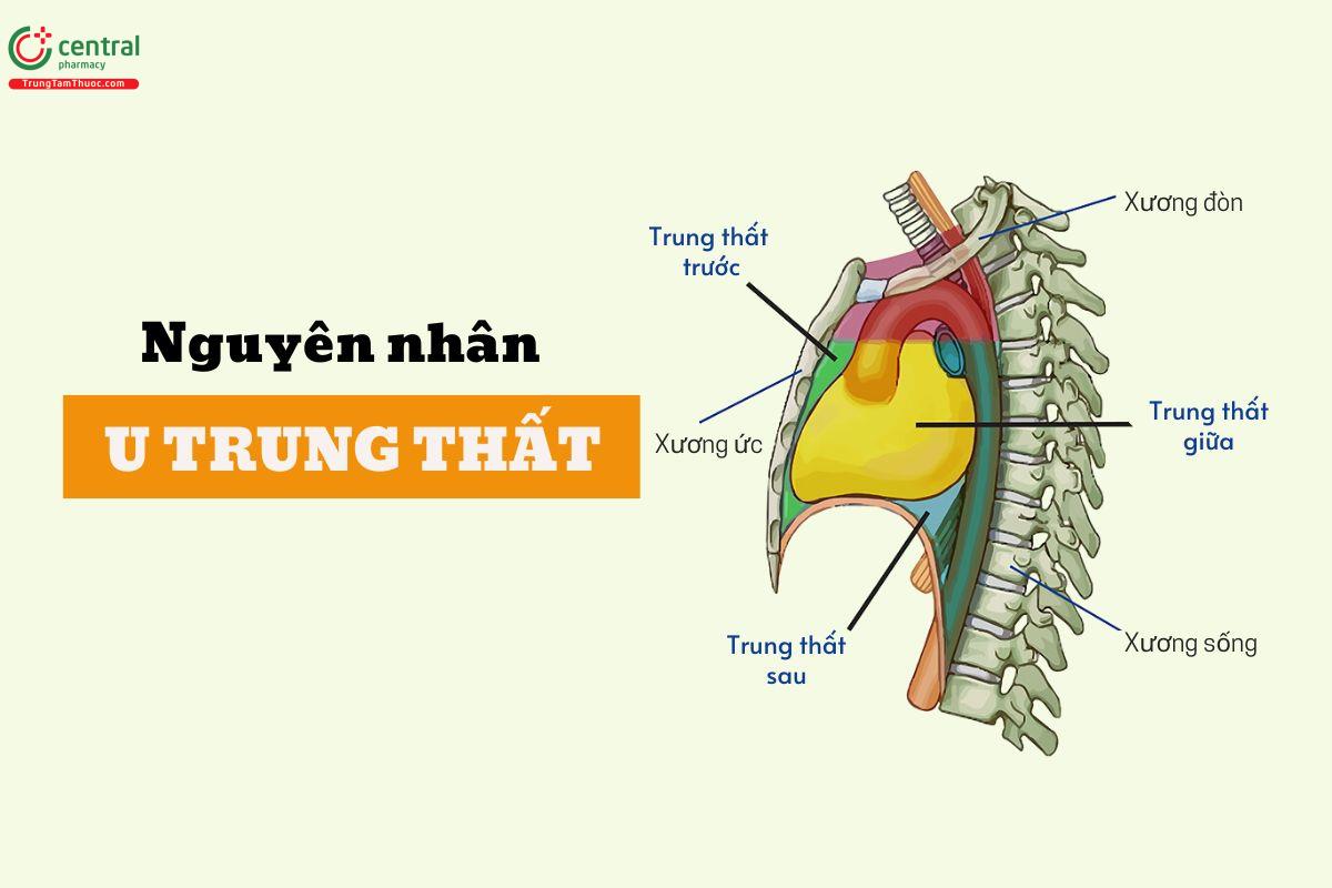 Nguyên nhân gây ra khối u trung thất