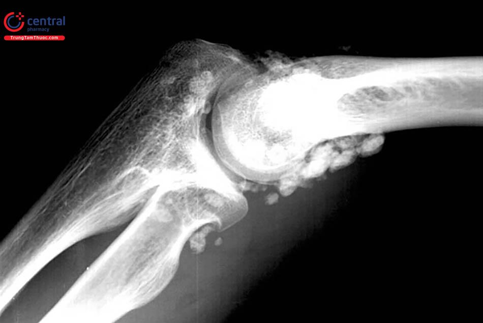 Chụp X-quang u sụn màng hoạt dịch