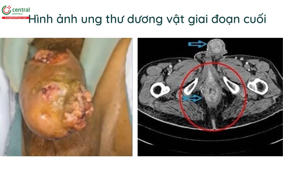 Ung thư dương vật giai đoạn cuối