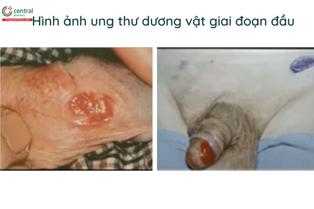 Ung thư dương vật giai đoạn đầu