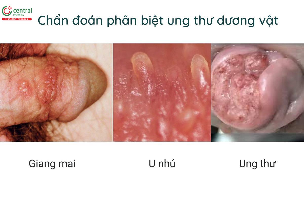 Chẩn đoán phân biệt ung thư dương vật